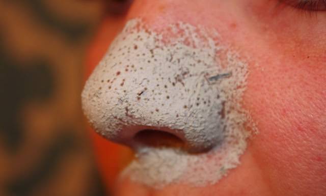 blackheads